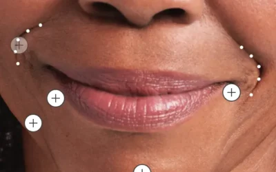 BUILD COLLAGEN & ELASTIN WITH RADIESSE®
