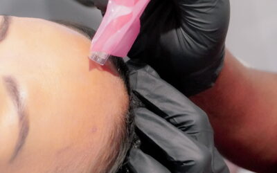 PRP Microneedling