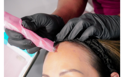 PRP Microneedling